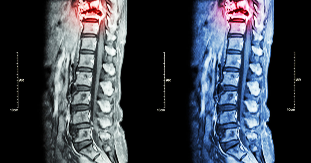 hidden injuries car accident spinal cord
